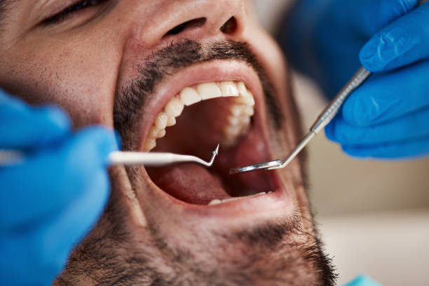 Best Emergency Root Canal Treatment in Renton, WA